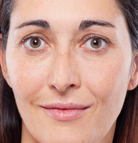 injections-volumisantes-cernes-levres-apres-2-464×480