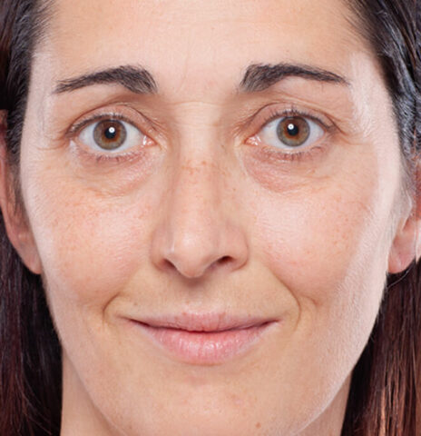 injections-volumisantes-cernes-levres-avant-2-464×480