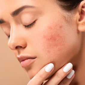 ROSACEA-mwsmedicalspa-in-Leesburg-FL