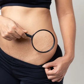 Stretch-marks-mwsmedicalspa-in-Leesburg-FL