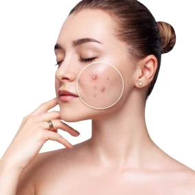 acne-mwsmedicalspa-in-Leesburg-FL