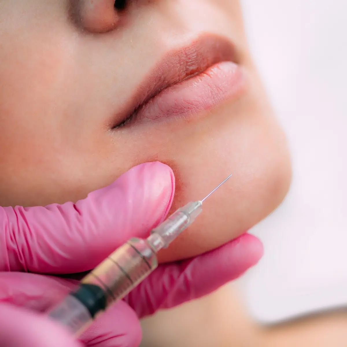 juvederm-benefits-mwsmedicalspa-in-Leesburg